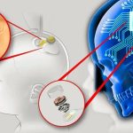 Neuralink Berhasil Tanam Chip Otak Kedua Atasi Kelumpuhan