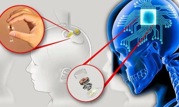 Neuralink Berhasil Tanam Chip Otak Kedua Atasi Kelumpuhan