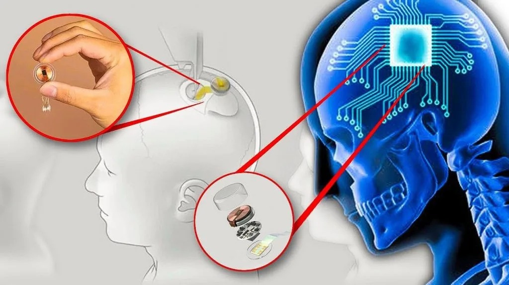 Neuralink Berhasil Tanam Chip Otak Kedua Atasi Kelumpuhan